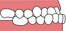 下の歯が前に出ている