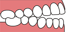 前歯が閉じない