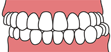 奥歯がずれている