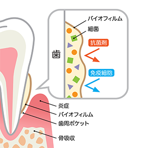 歯周病の原因と進行