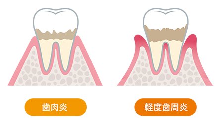 歯肉炎、軽度歯肉炎