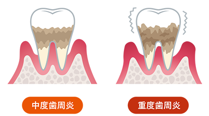 中度歯肉炎、重度歯肉炎